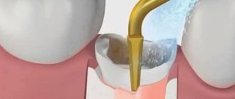 Без боли и осложнений: как проходит удаление зуба ультразвуком