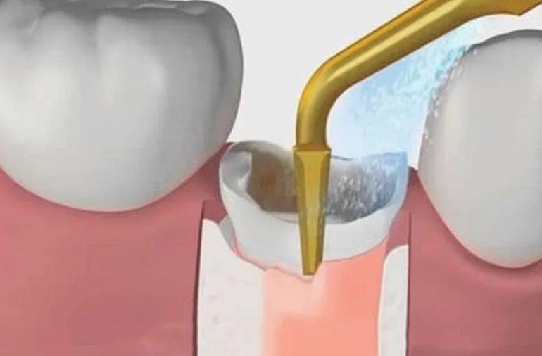 Без боли и осложнений: как проходит удаление зуба ультразвуком